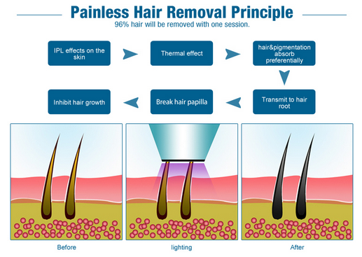 συσκευή αφαίρεσης τρίχας 808nm DIY IPL, Remover τρίχας λέιζερ προσώπου οθόνης αφής LCD