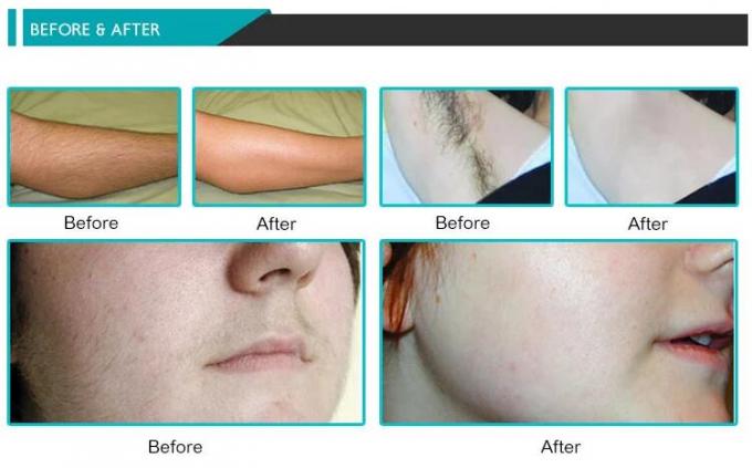 Hairfree 808 μηχανή 3 λέιζερ NM IPL μήκη κύματος για όλο το καλό δέρμα χρώματος